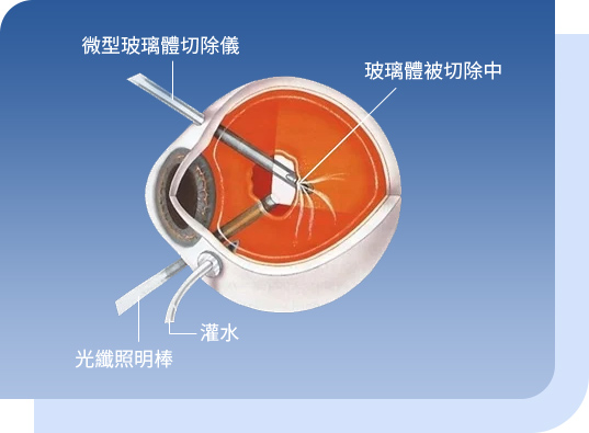 希瑪眼科中心_視網膜脫落治療_微創玻璃體切除術